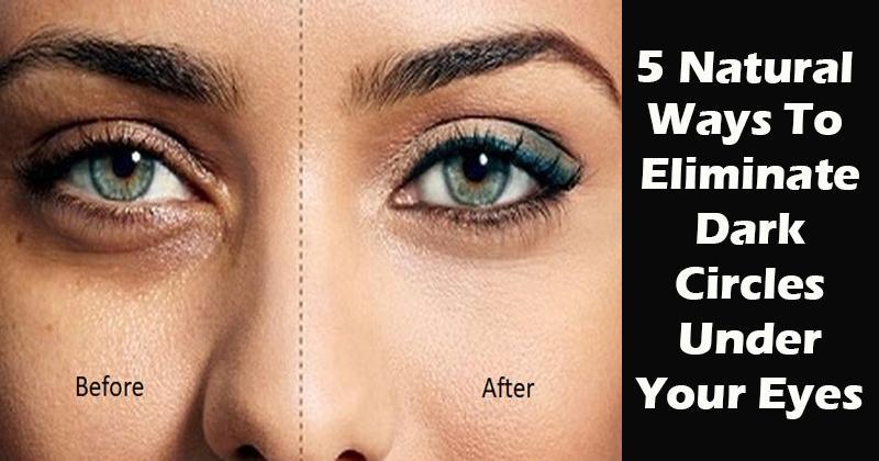 5 Natural Ways to Get Rid of Dark Circles Under Your Eyes