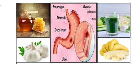 Remedies For Ulcer