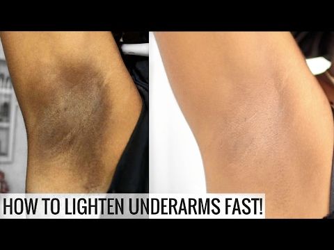Top 5 Methods To Lighten Your Underarms