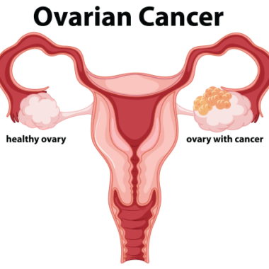 Ovarian Cancer: Causes, Symptoms, Risk Factor, Treatment