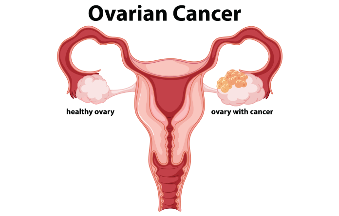 Ovarian Cancer: Causes, Symptoms, Risk Factor, Treatment